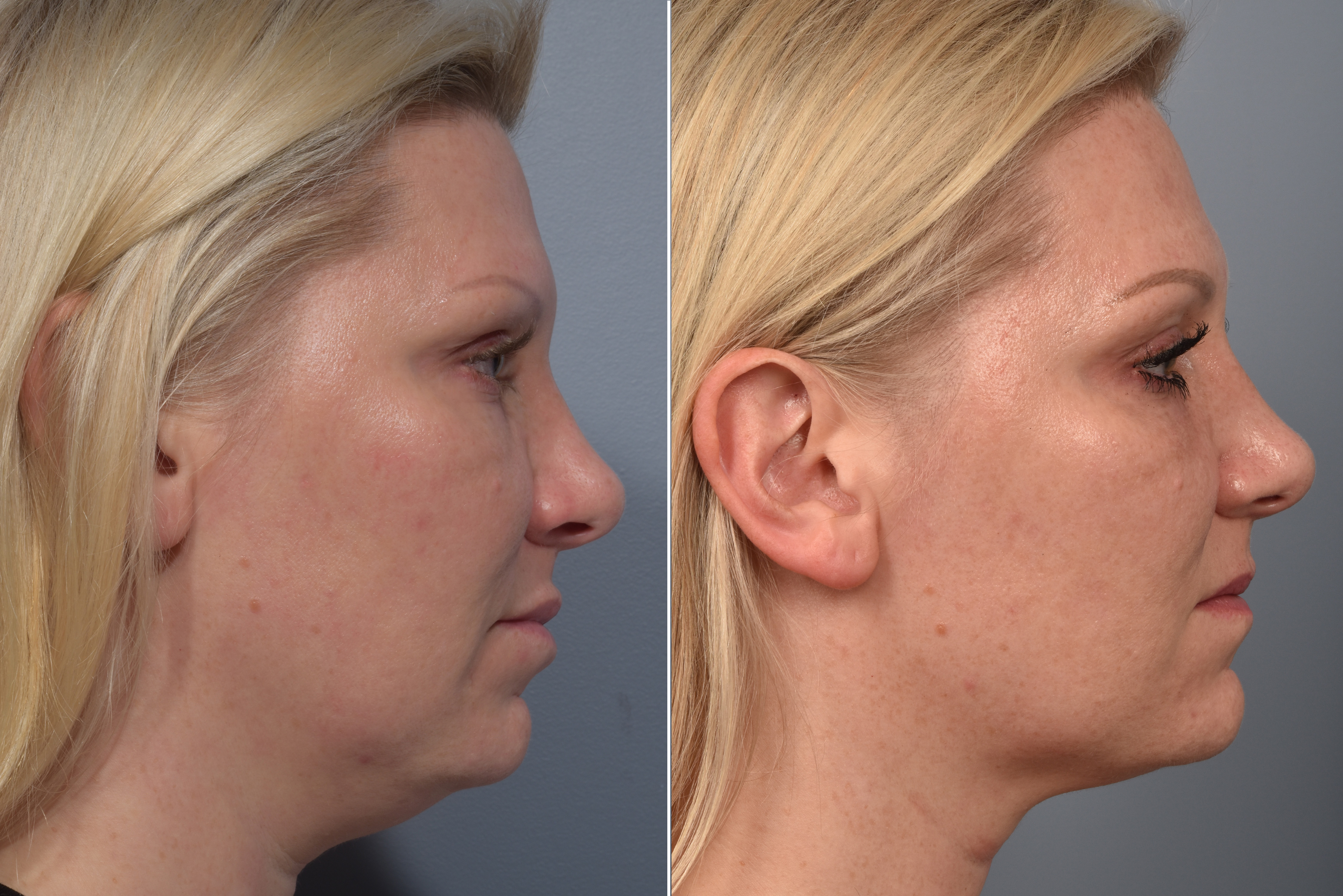 Neck Lift Before & After Gallery - Patient 709611 - Image 7