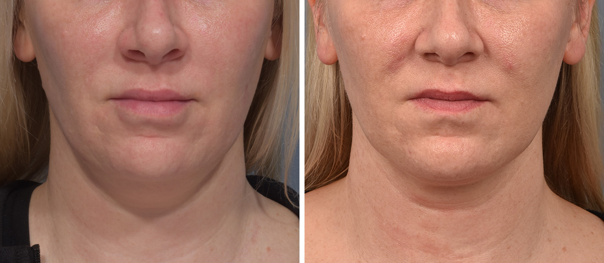 Neck Lift Before & After Gallery - Patient 709611 - Image 3