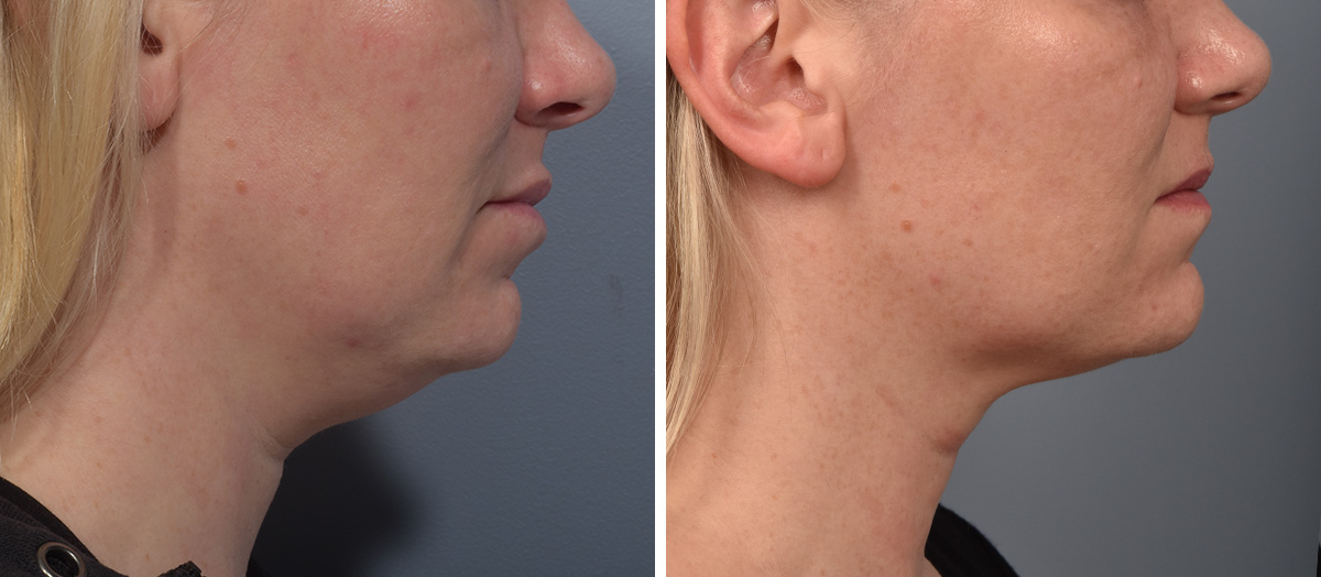 Neck Lift Before & After Gallery - Patient 709611 - Image 2