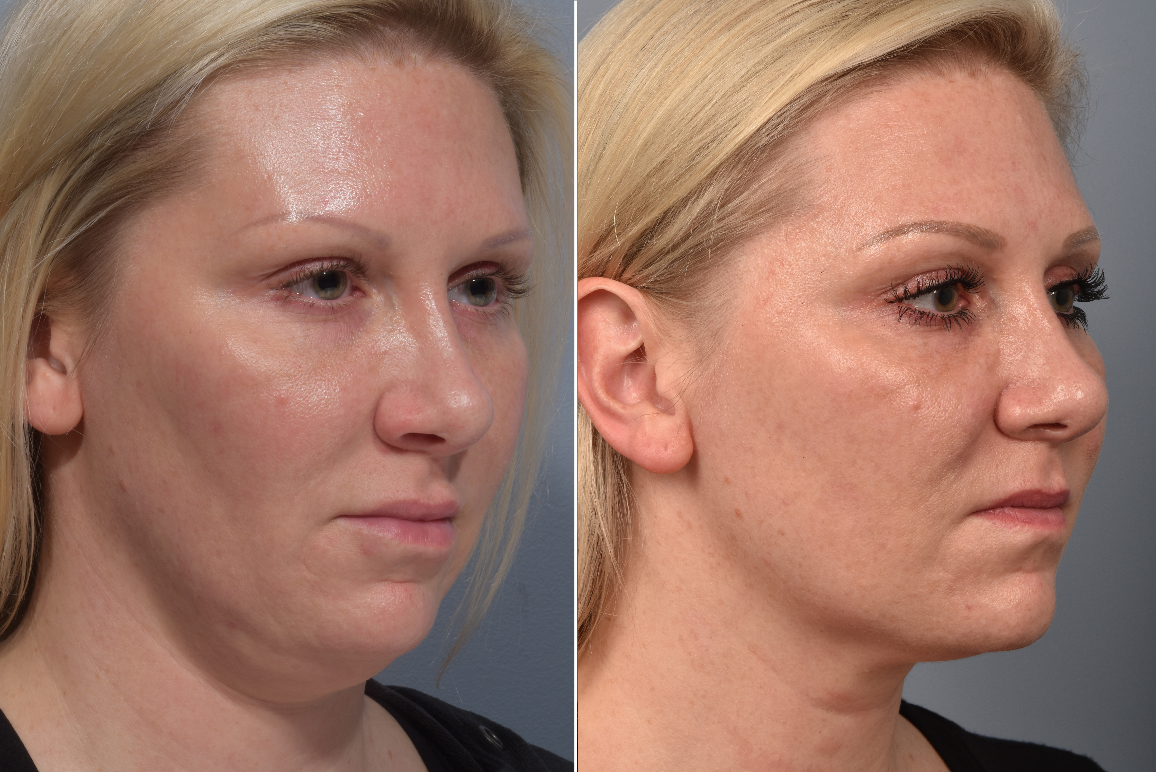 Neck Lift Before & After Gallery - Patient 709611 - Image 6