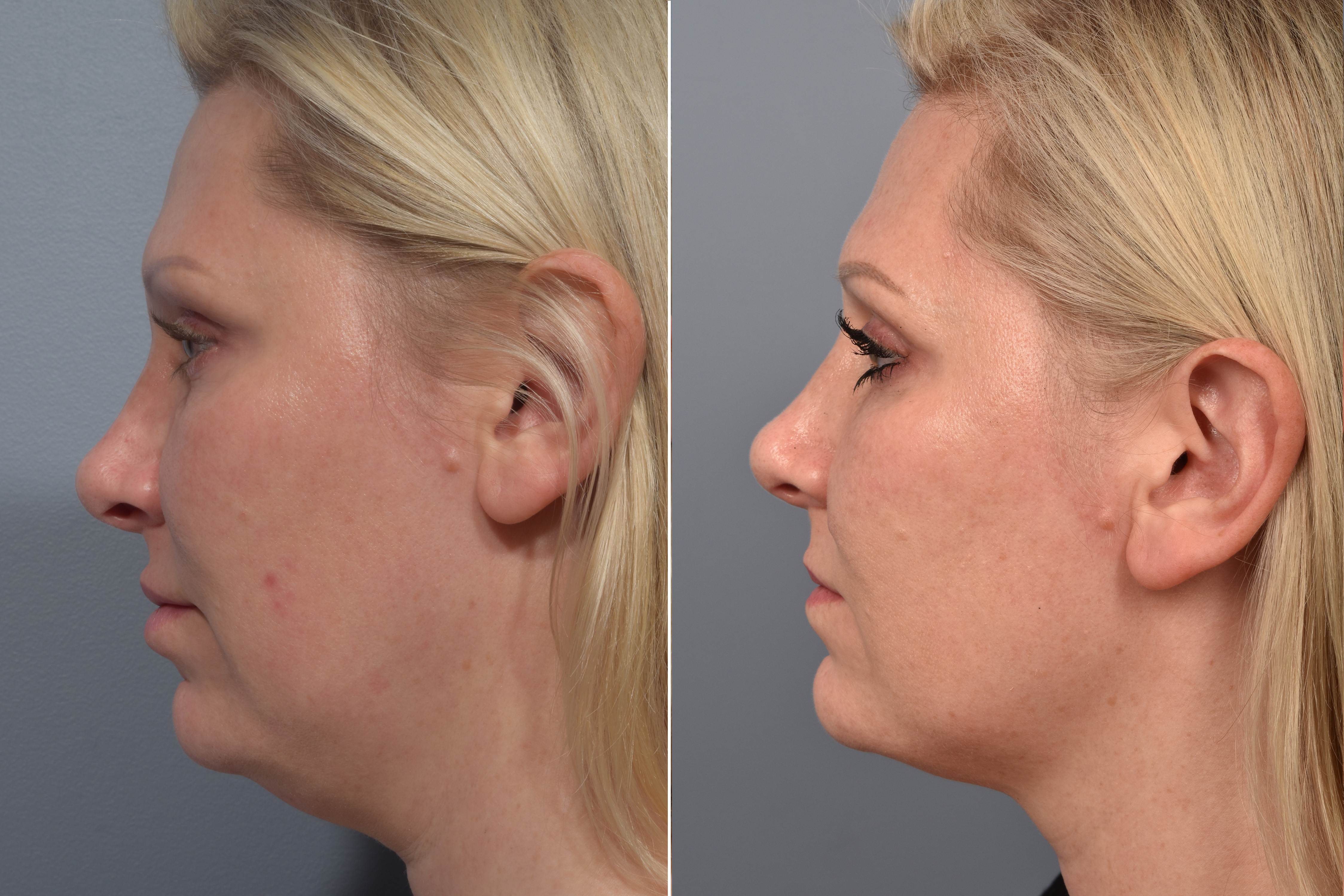 Neck Lift Before & After Gallery - Patient 709611 - Image 10