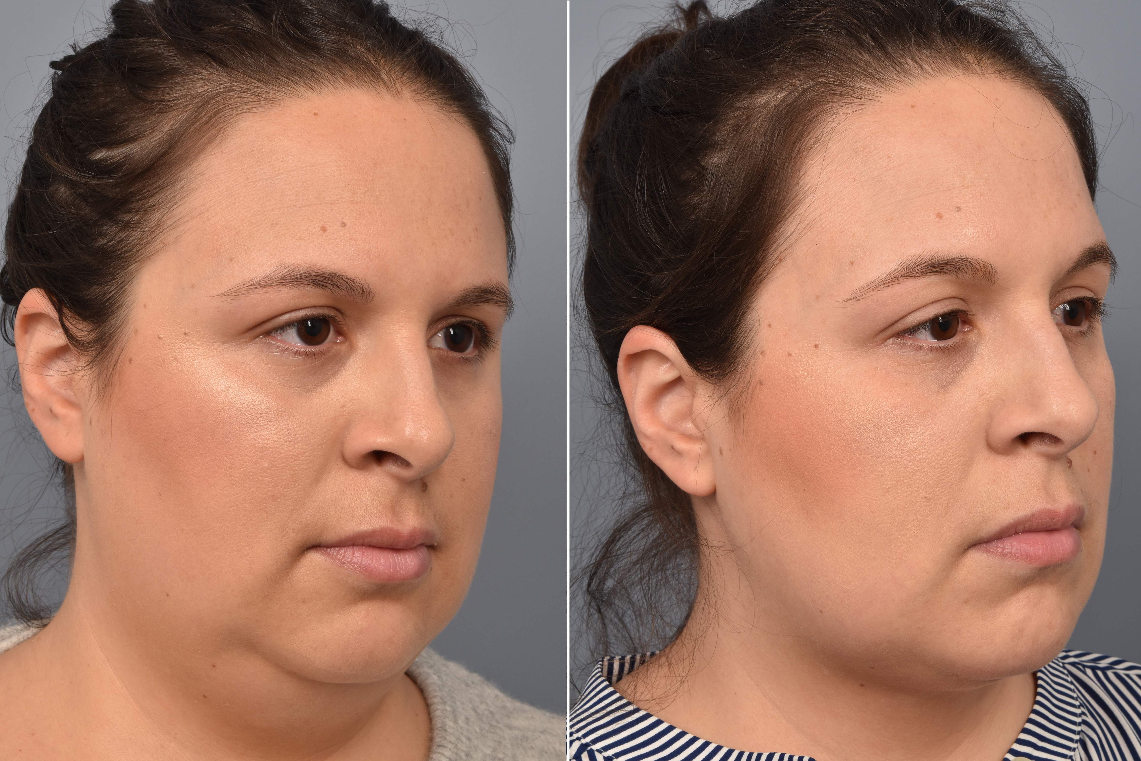 Neck Lift Before & After Gallery - Patient 351740 - Image 6