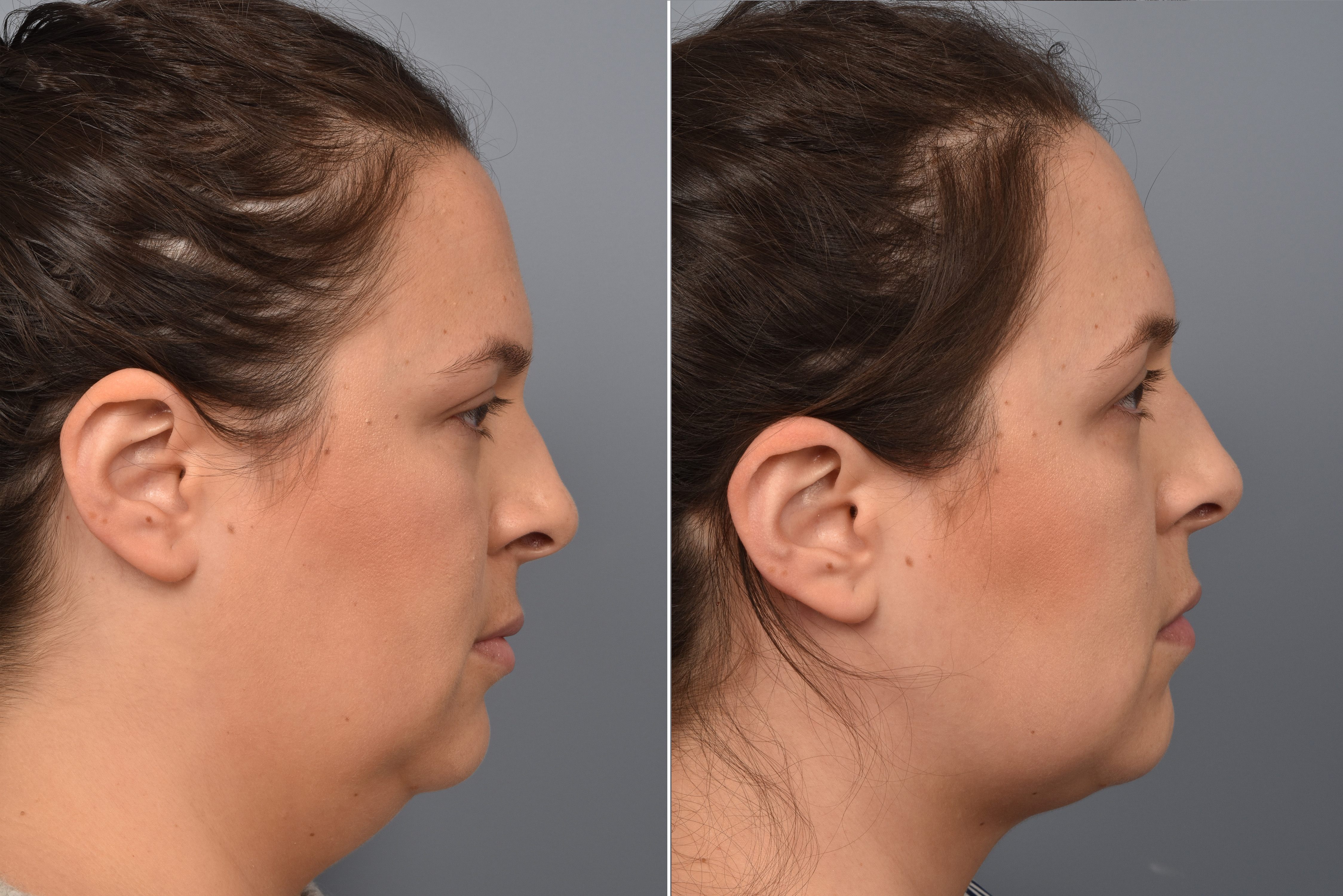 Neck Lift Before & After Gallery - Patient 351740 - Image 7