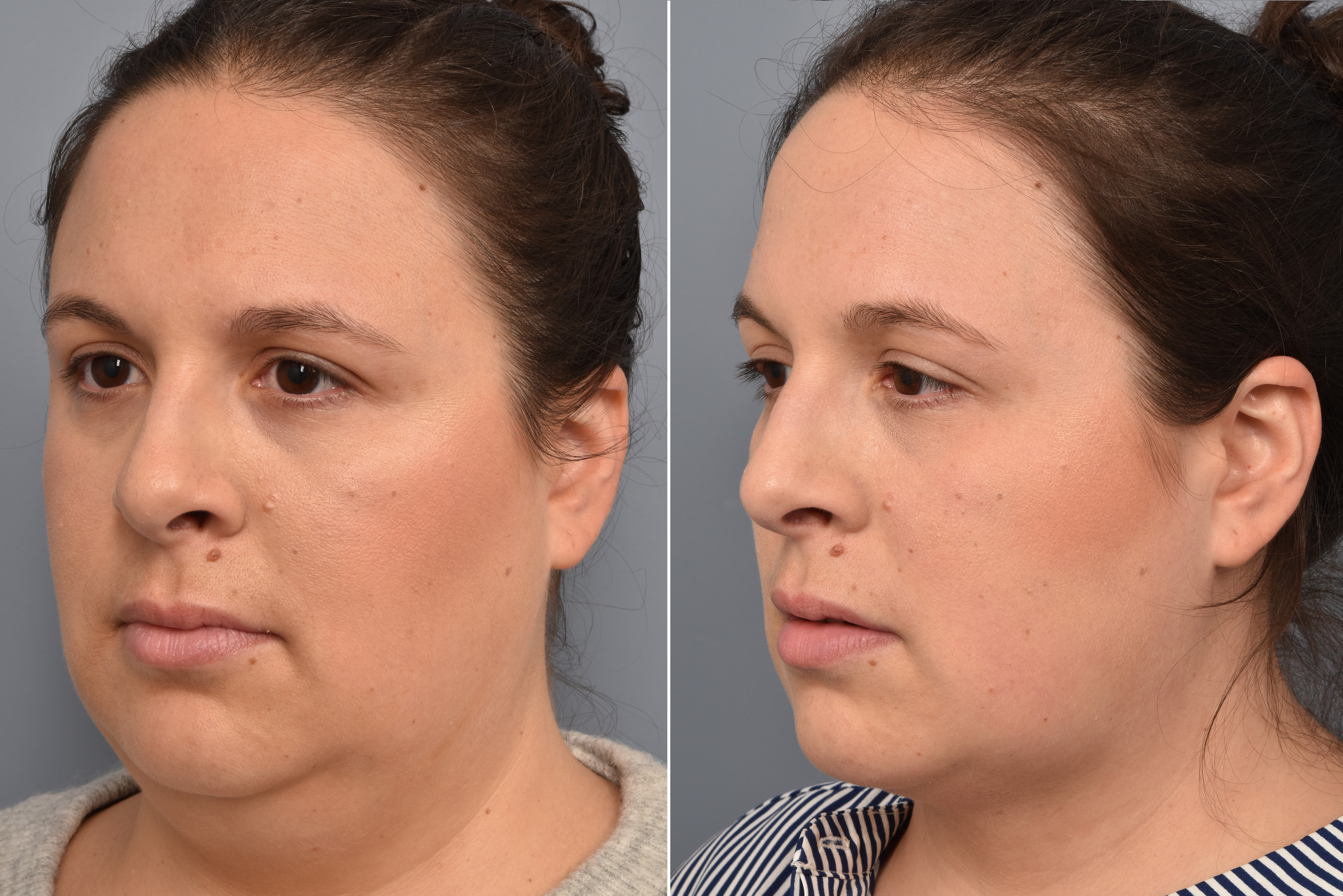 Neck Lift Before & After Gallery - Patient 351740 - Image 9