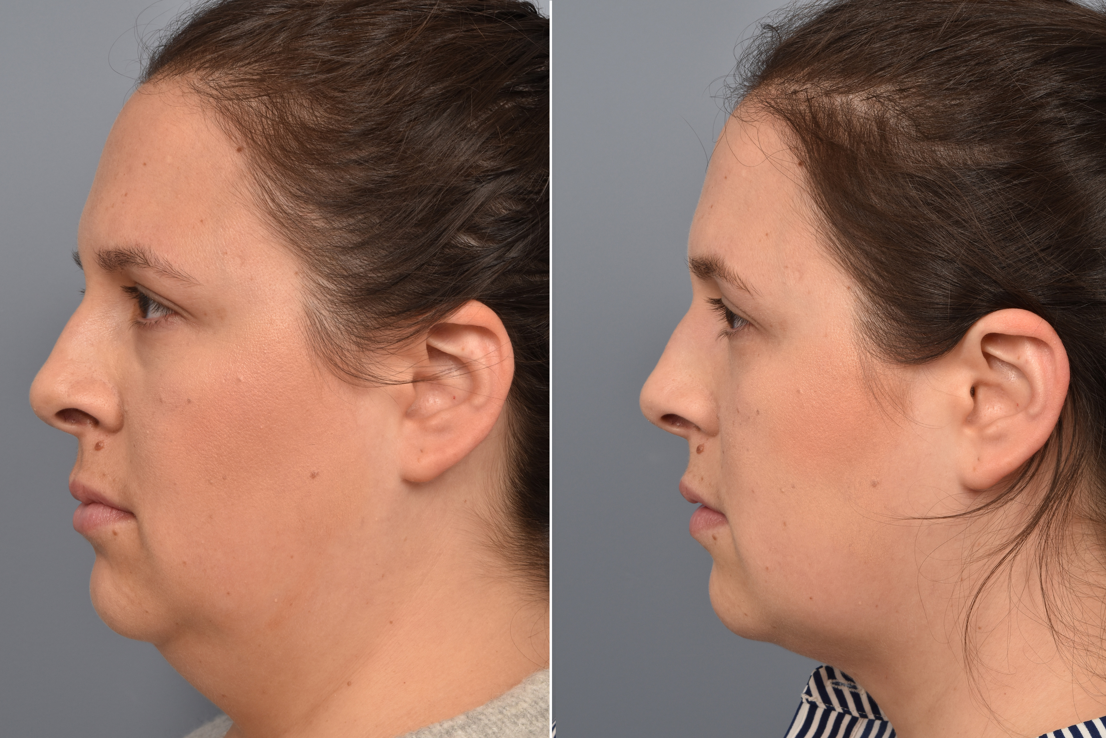 Neck Lift Before & After Gallery - Patient 351740 - Image 10