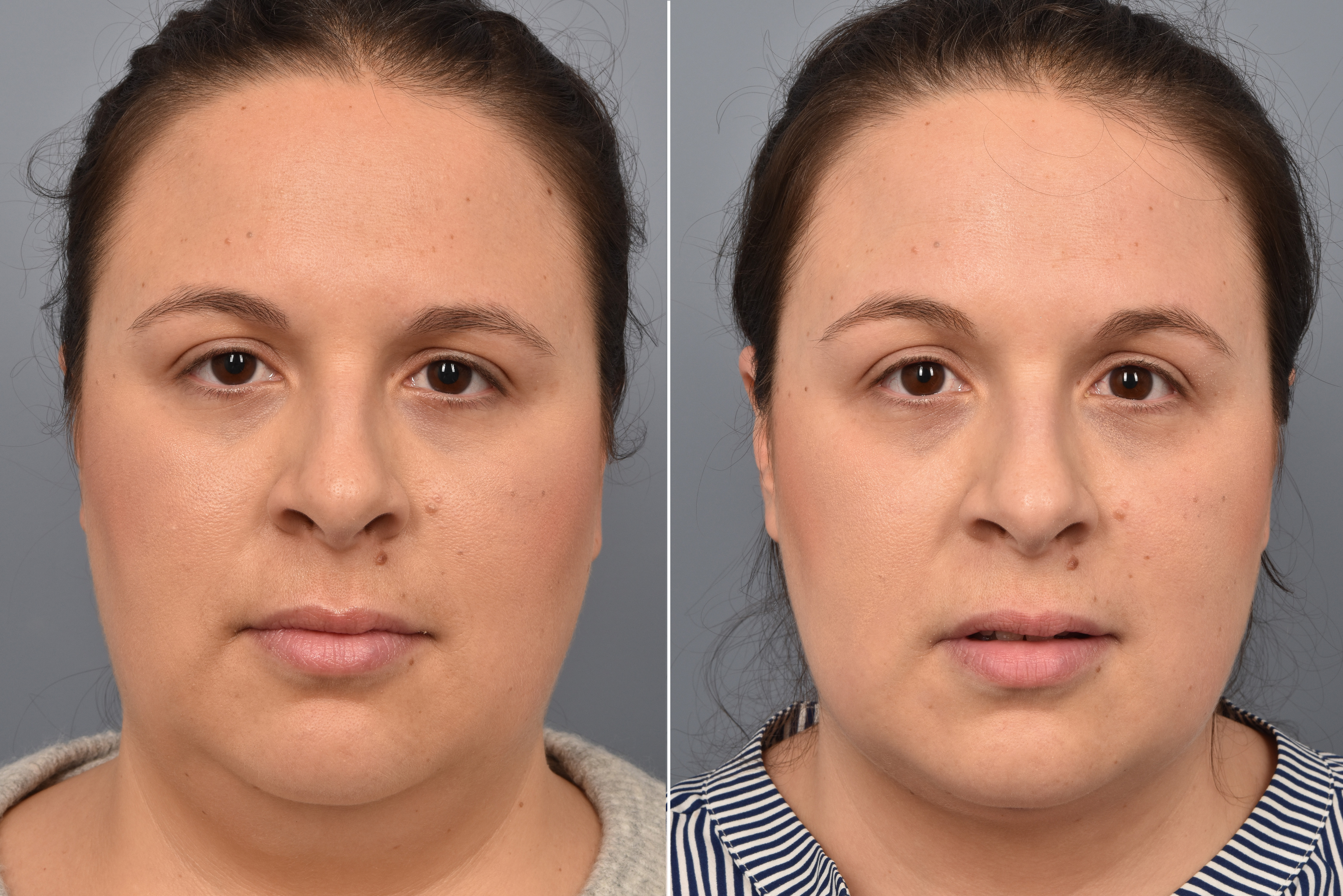 Neck Lift Before & After Gallery - Patient 351740 - Image 8