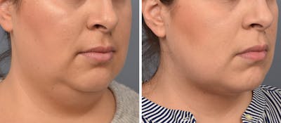 Neck Lift Before & After Gallery - Patient 351740 - Image 1