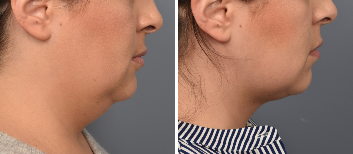 Neck Lift Before & After Gallery - Patient 351740 - Image 2