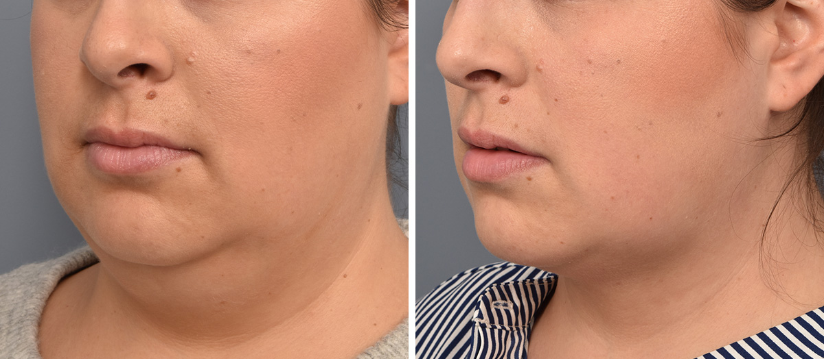 Neck Lift Before & After Gallery - Patient 351740 - Image 4