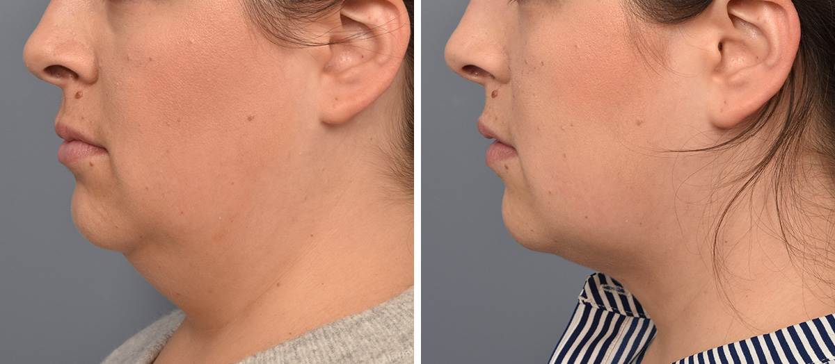 Neck Lift Before & After Gallery - Patient 351740 - Image 5