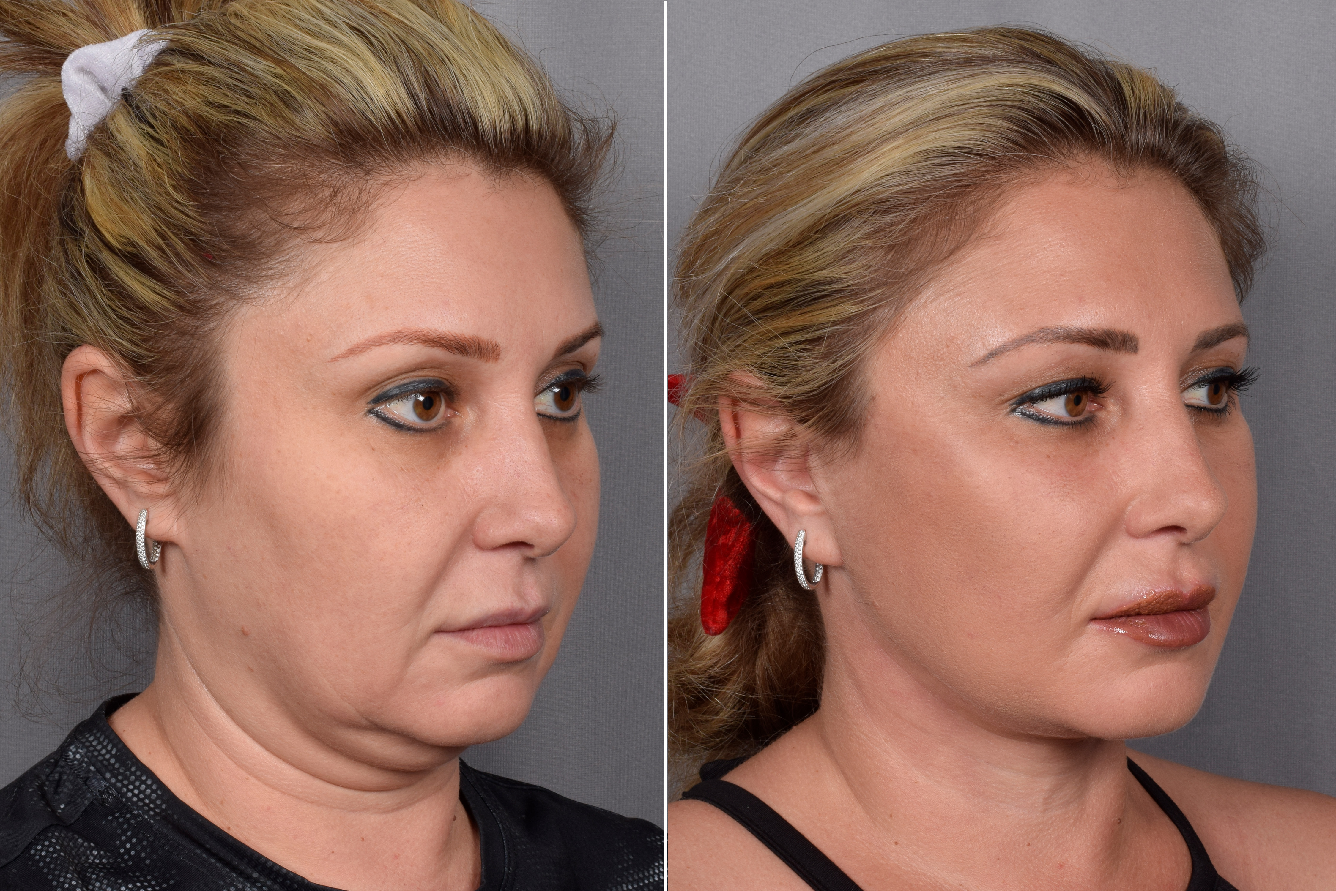 Neck Lift Before & After Gallery - Patient 148544 - Image 4