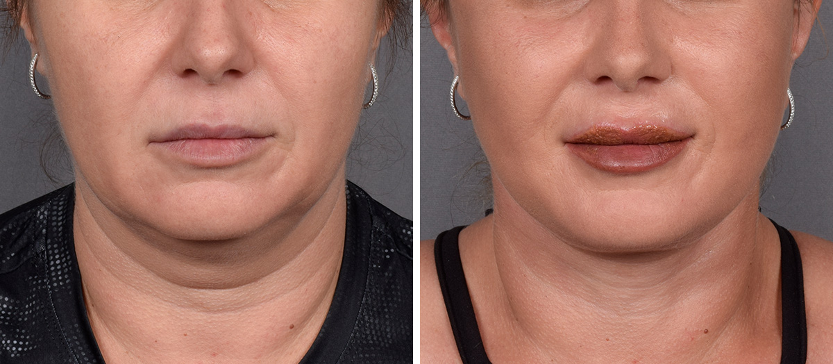 Neck Lift Before & After Gallery - Patient 148544 - Image 2
