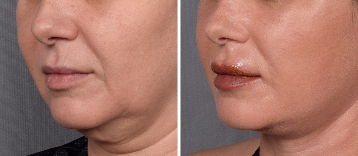 Neck Lift Before & After Gallery - Patient 148544 - Image 3
