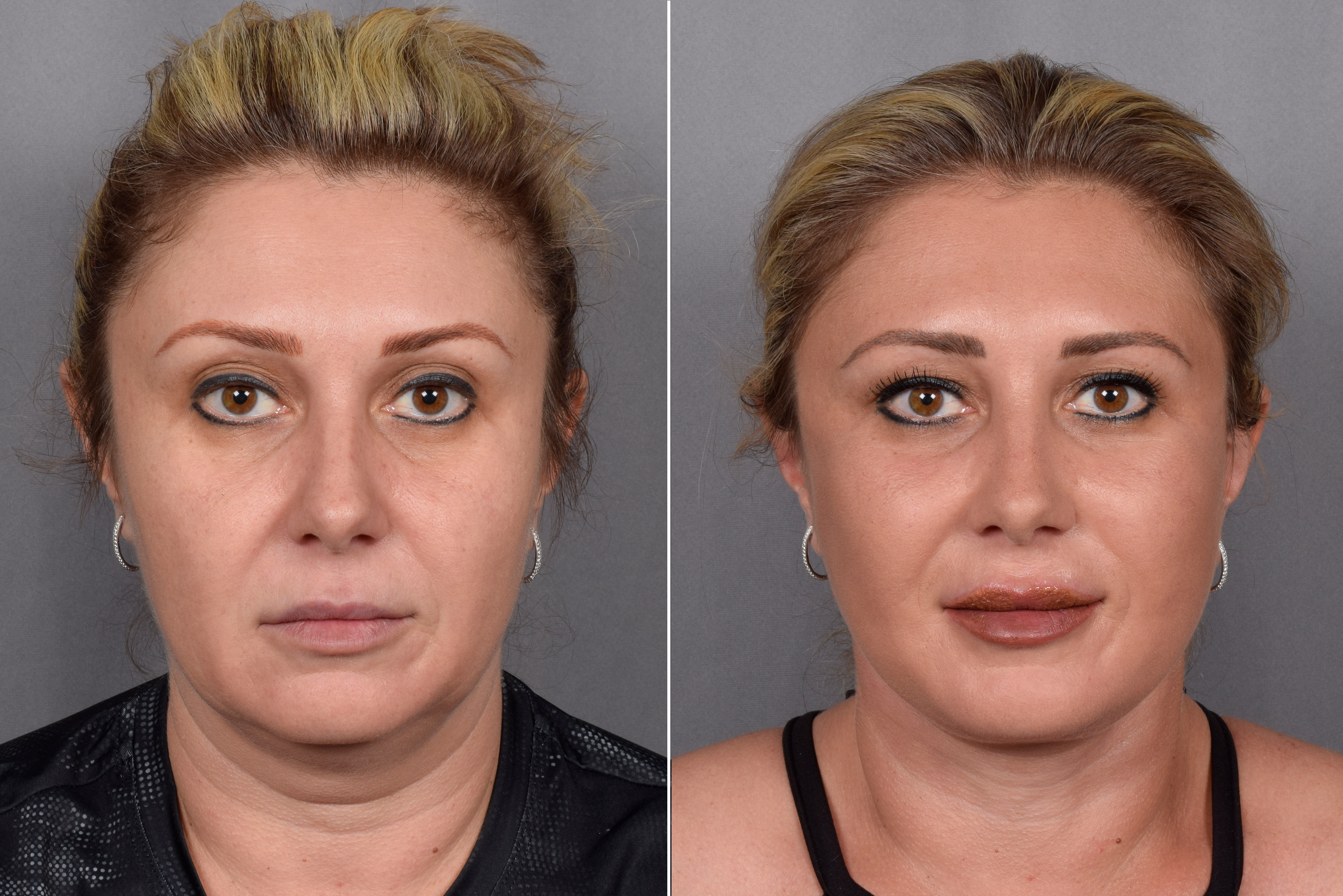 Neck Lift Before & After Gallery - Patient 148544 - Image 5