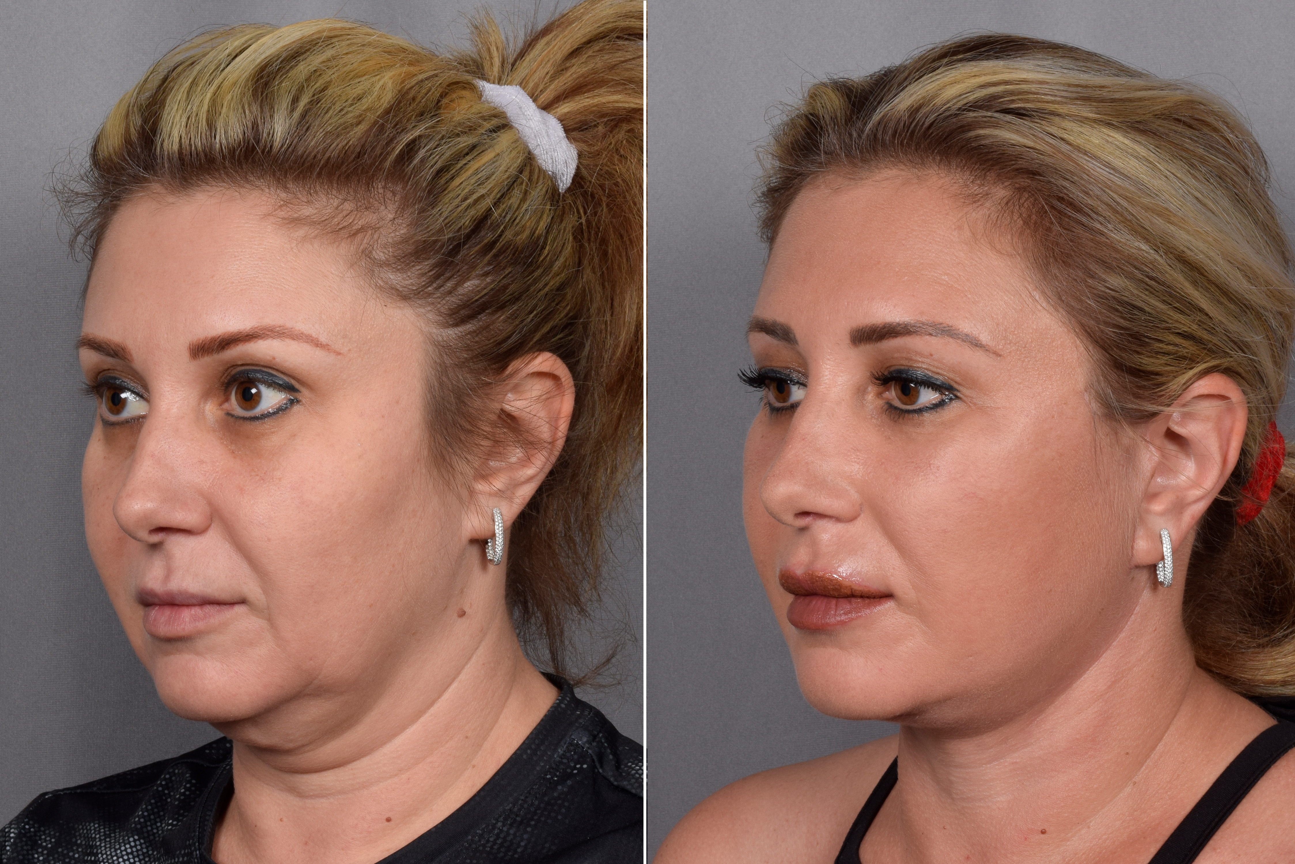 Neck Lift Before & After Gallery - Patient 148544 - Image 6