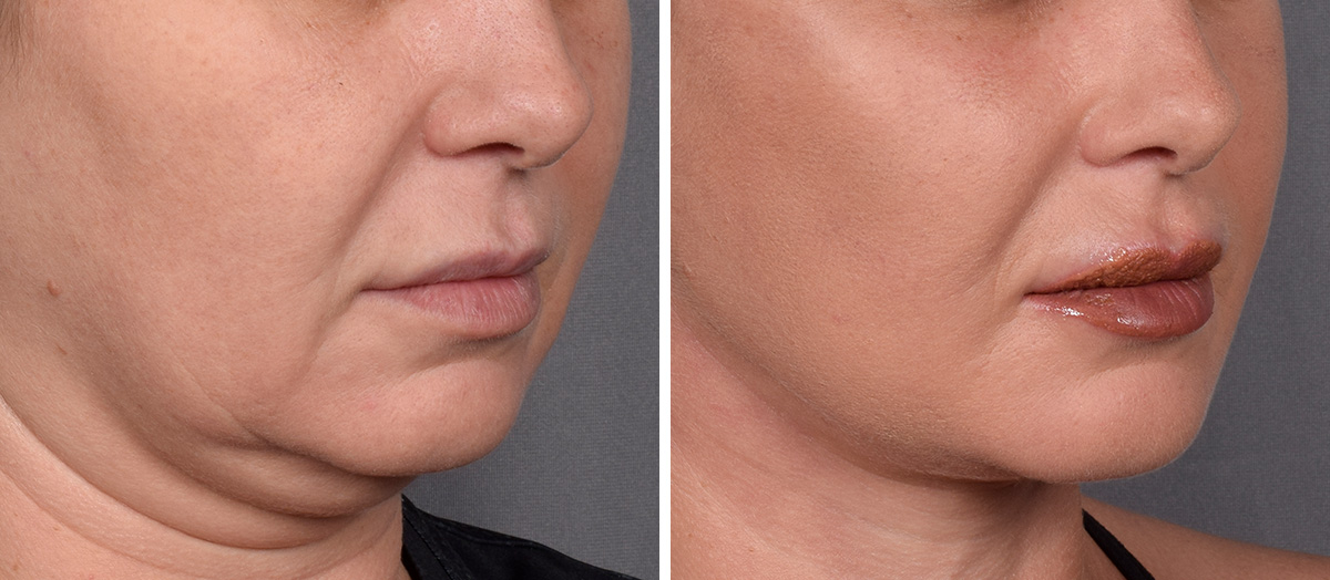 Neck Lift Before & After Gallery - Patient 148544 - Image 1