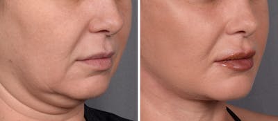 Neck Lift Before & After Gallery - Patient 148544 - Image 1