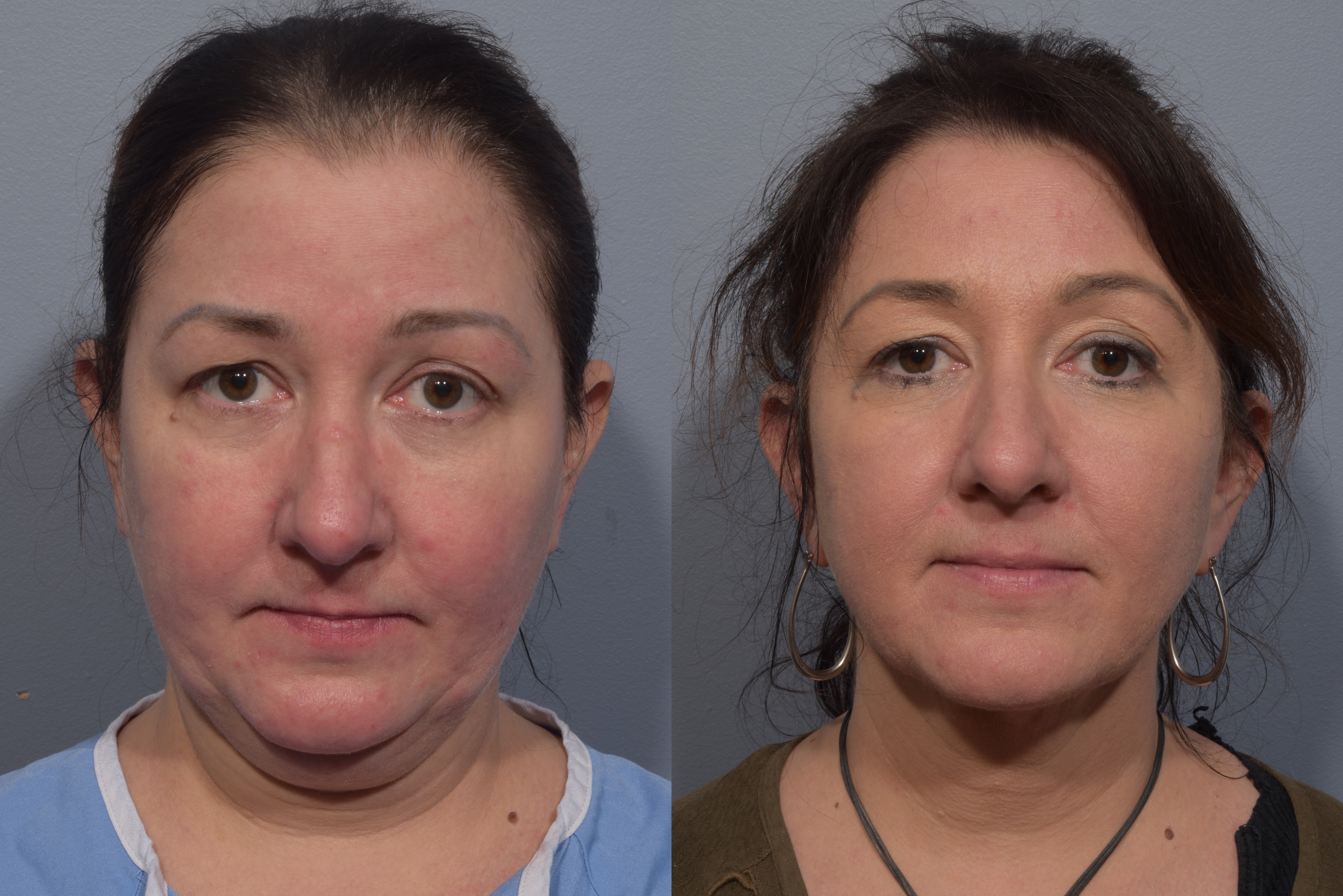 Neck Lift Before & After Gallery - Patient 380851 - Image 8