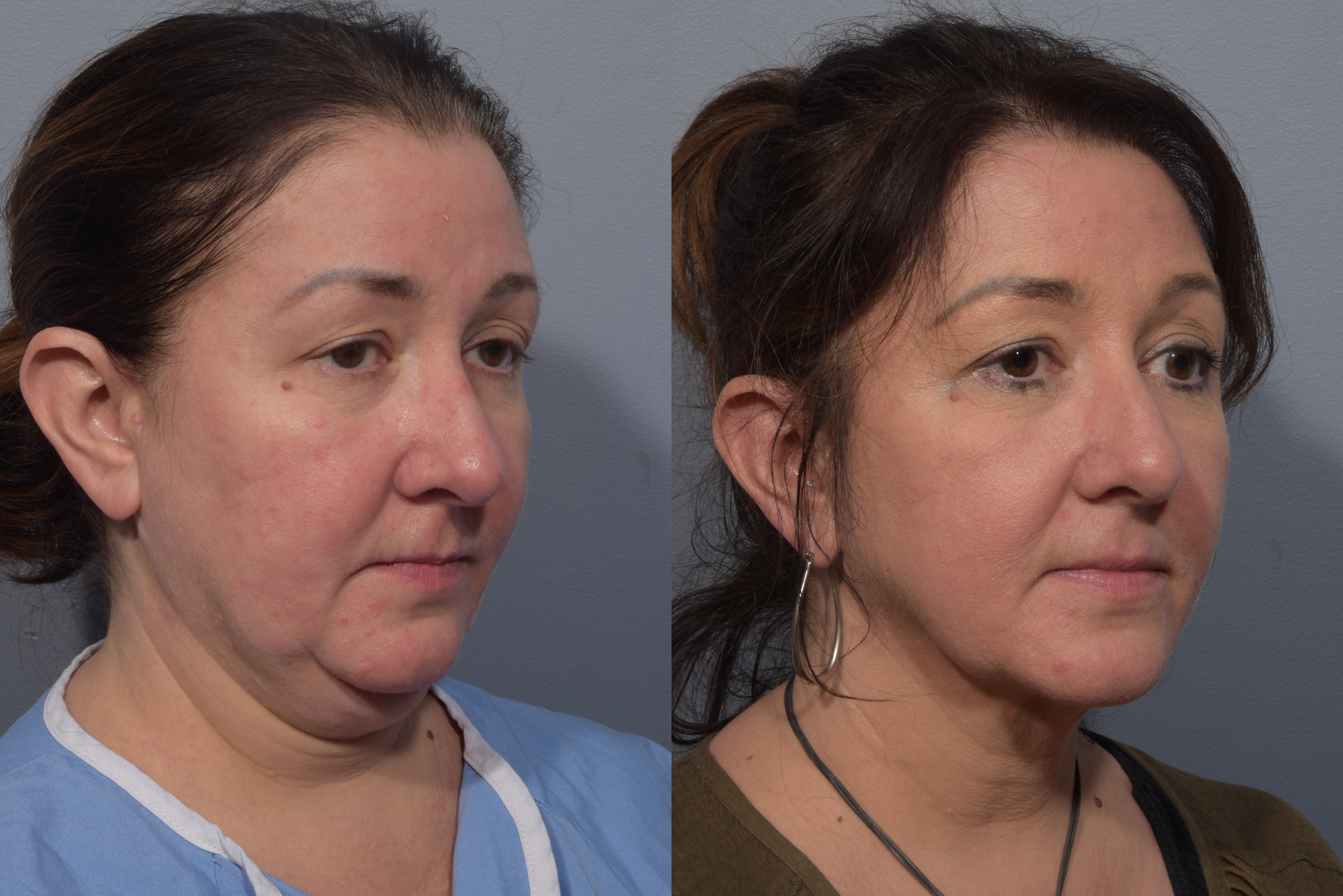 Neck Lift Before & After Gallery - Patient 380851 - Image 6