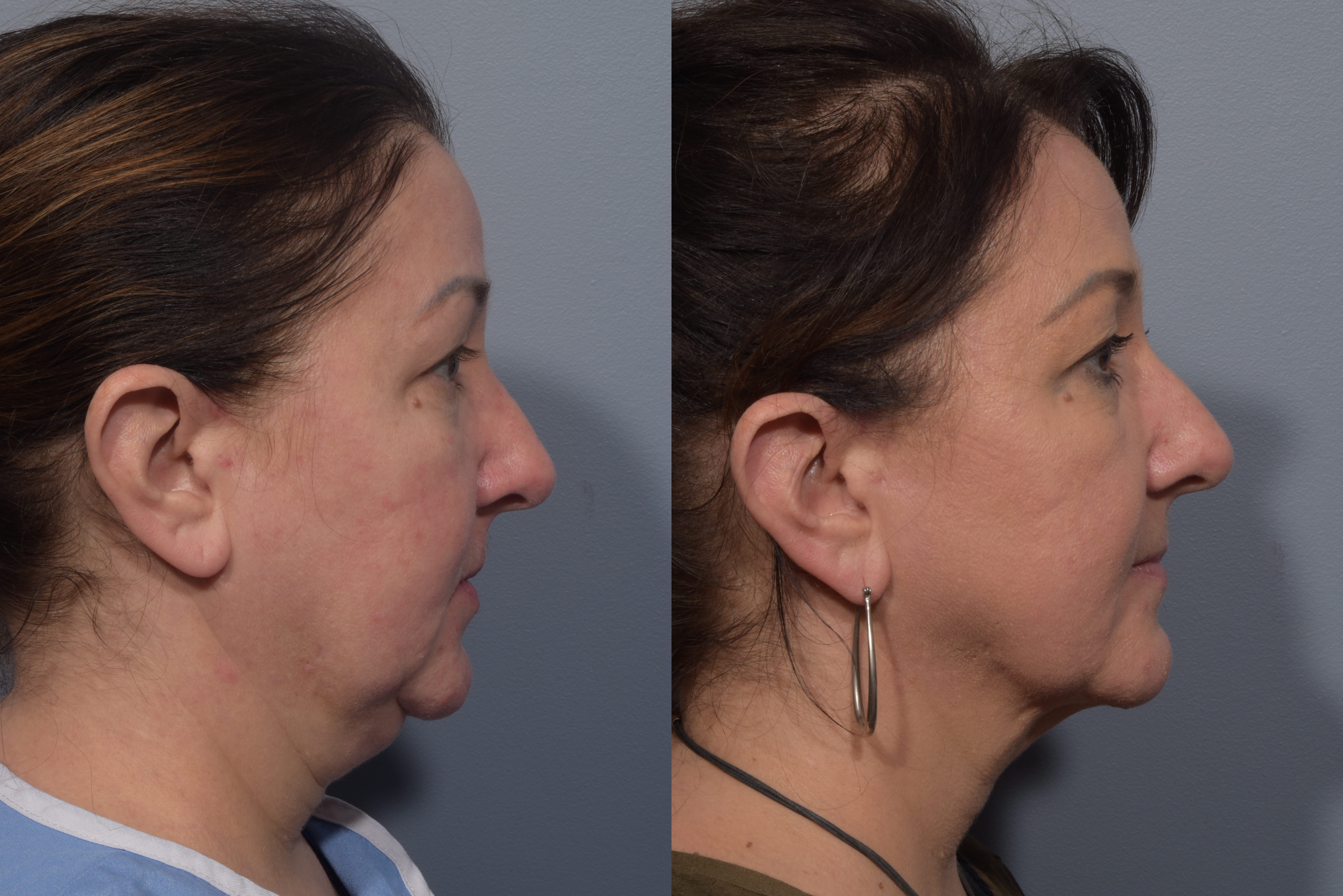 Neck Lift Before & After Gallery - Patient 380851 - Image 7