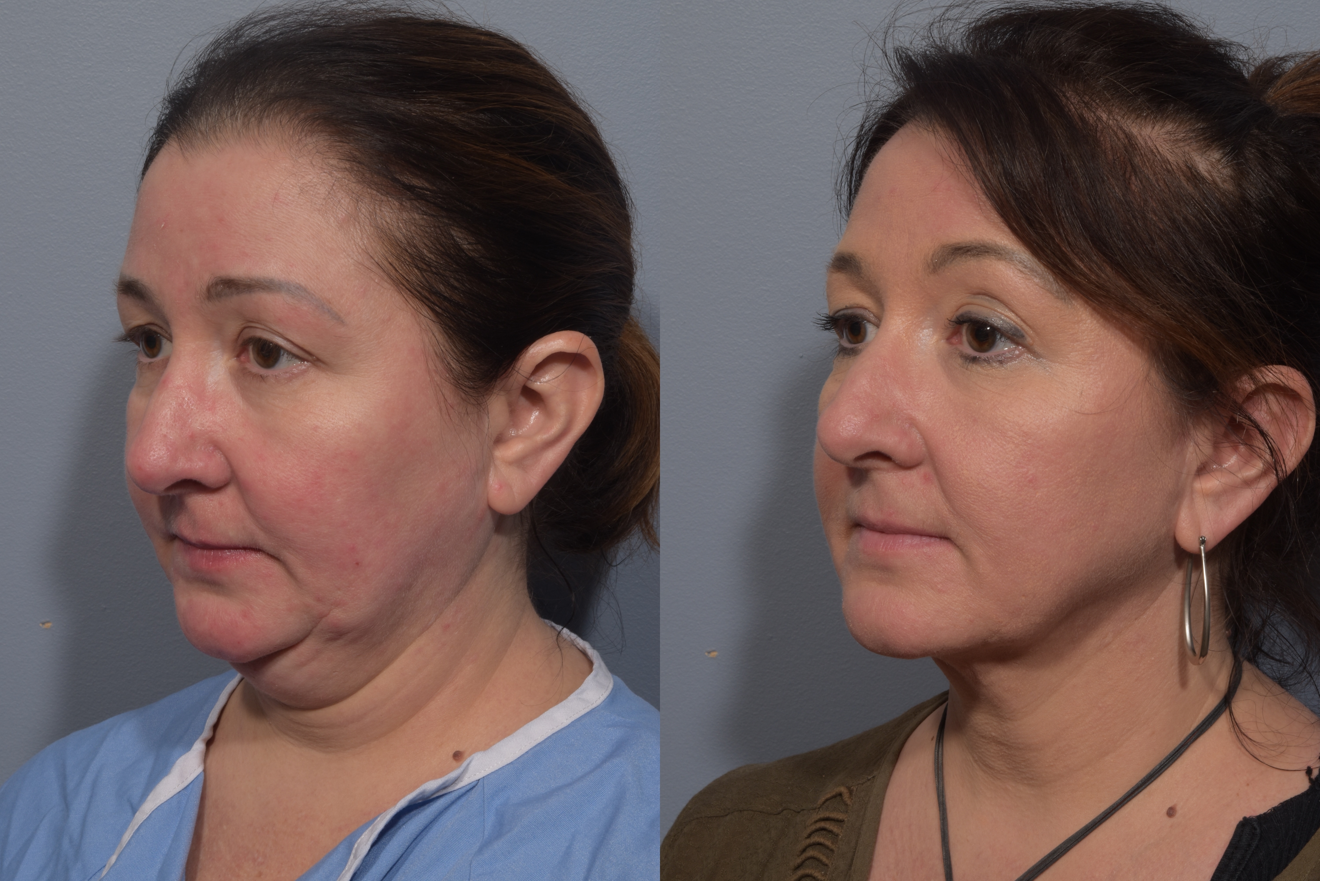 Neck Lift Before & After Gallery - Patient 380851 - Image 9