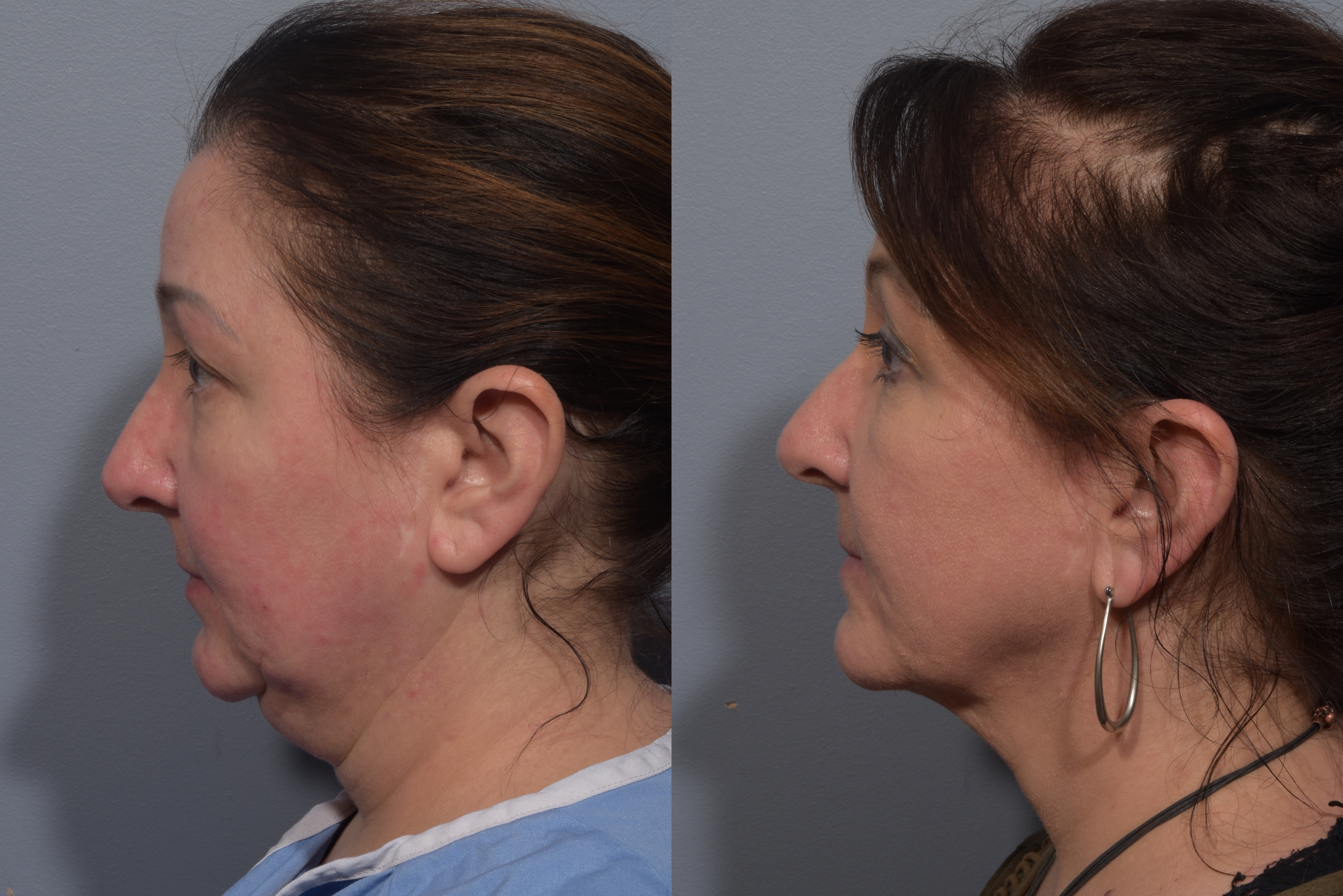 Neck Lift Before & After Gallery - Patient 380851 - Image 10