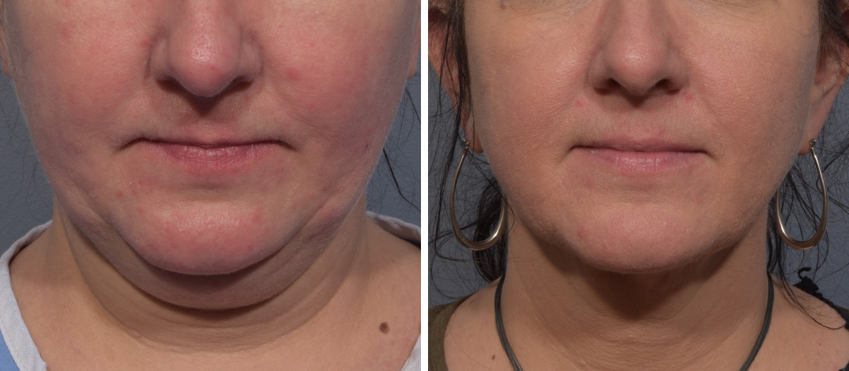 Neck Lift Before & After Gallery - Patient 380851 - Image 3