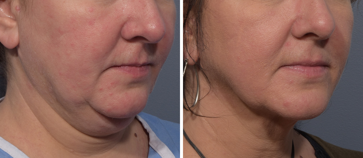 Neck Lift Before & After Gallery - Patient 380851 - Image 1