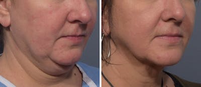 Neck Lift Before & After Gallery - Patient 380851 - Image 1