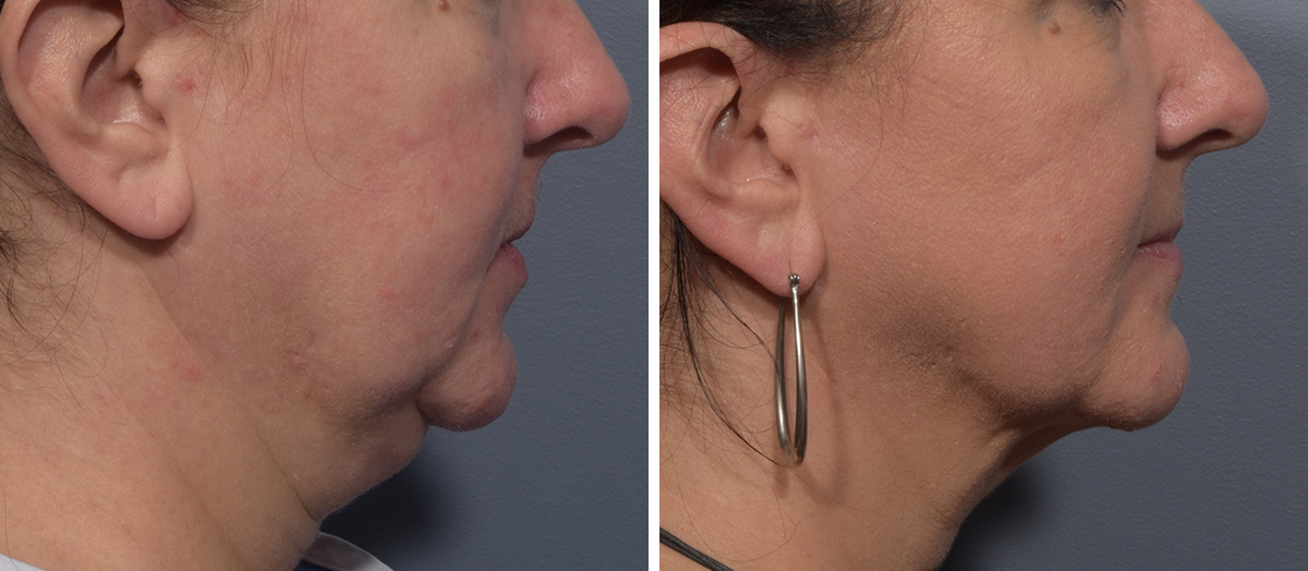 Neck Lift Before & After Gallery - Patient 380851 - Image 2