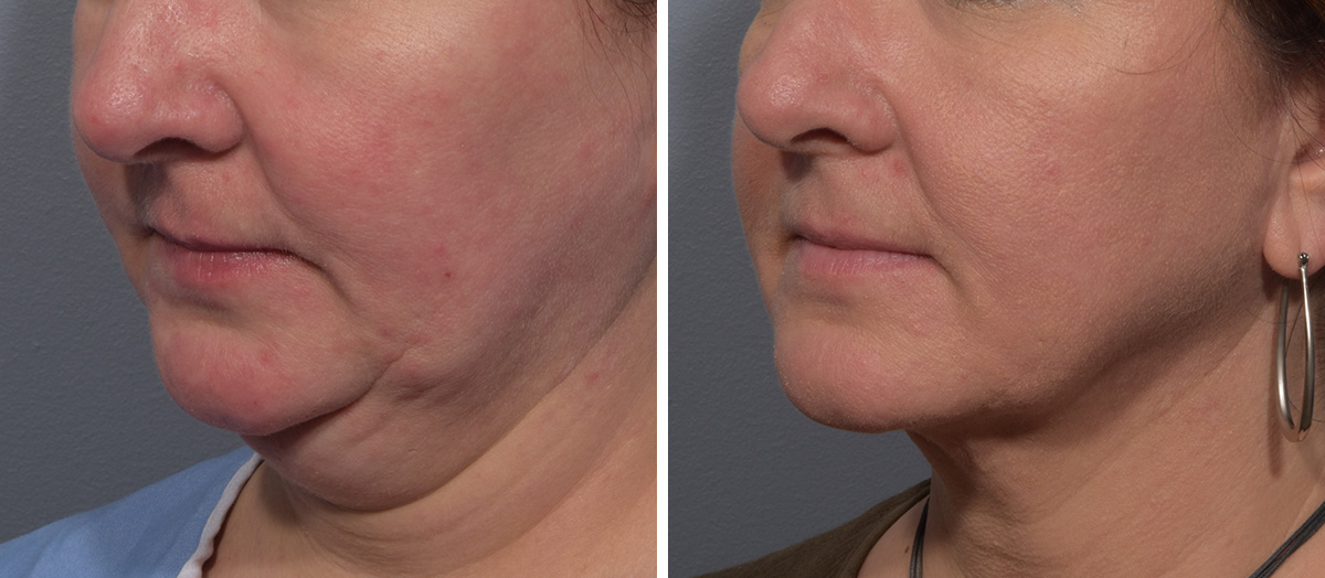 Neck Lift Before & After Gallery - Patient 380851 - Image 4