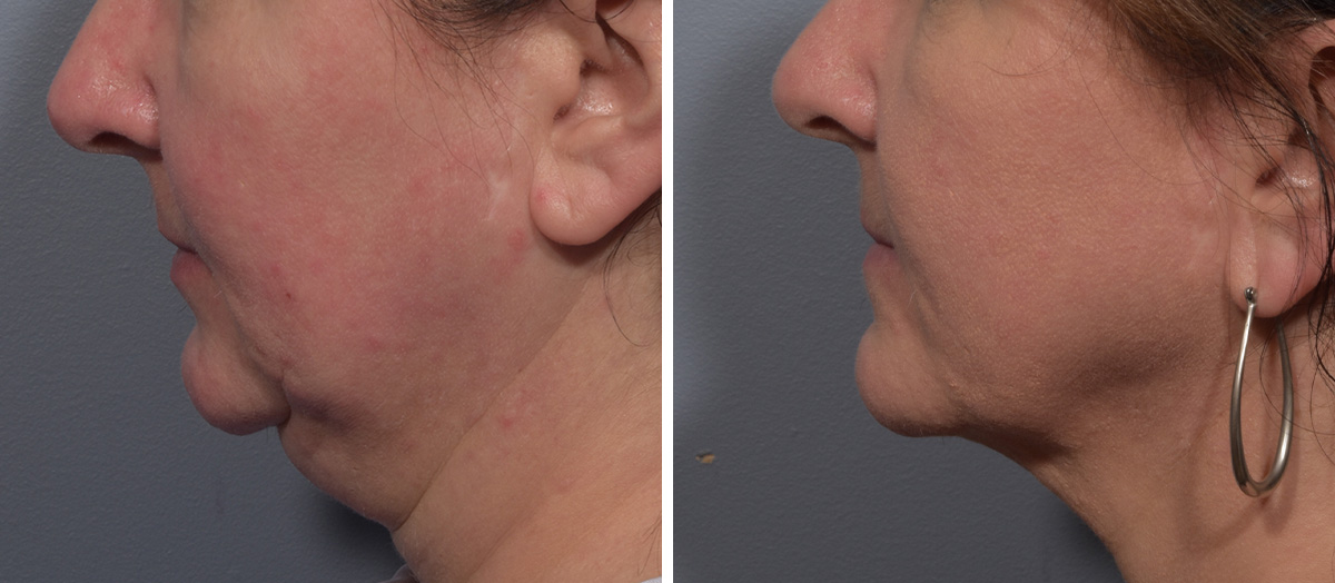 Neck Lift Before & After Gallery - Patient 380851 - Image 5