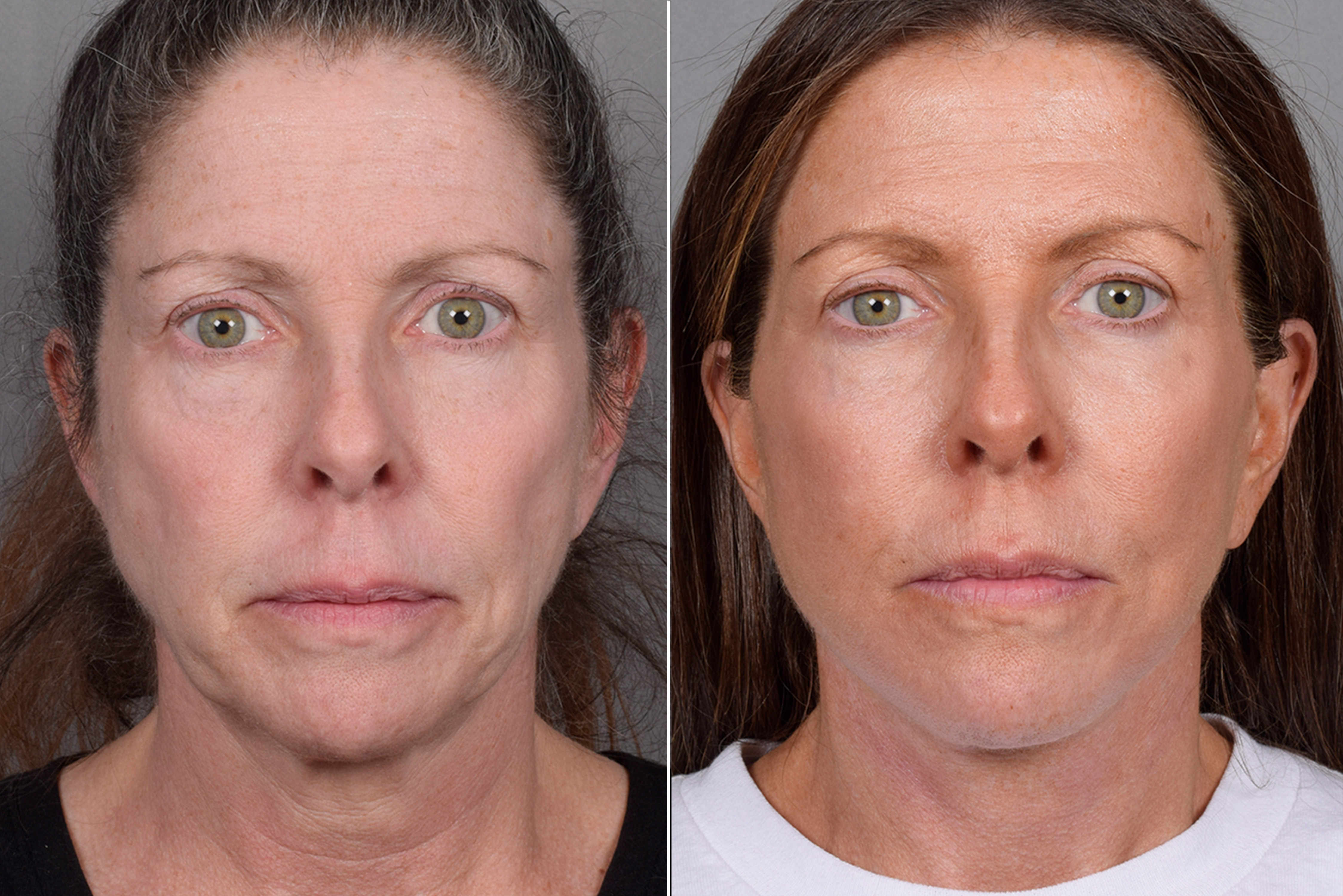 Neck Lift Before & After Gallery - Patient 607979 - Image 8