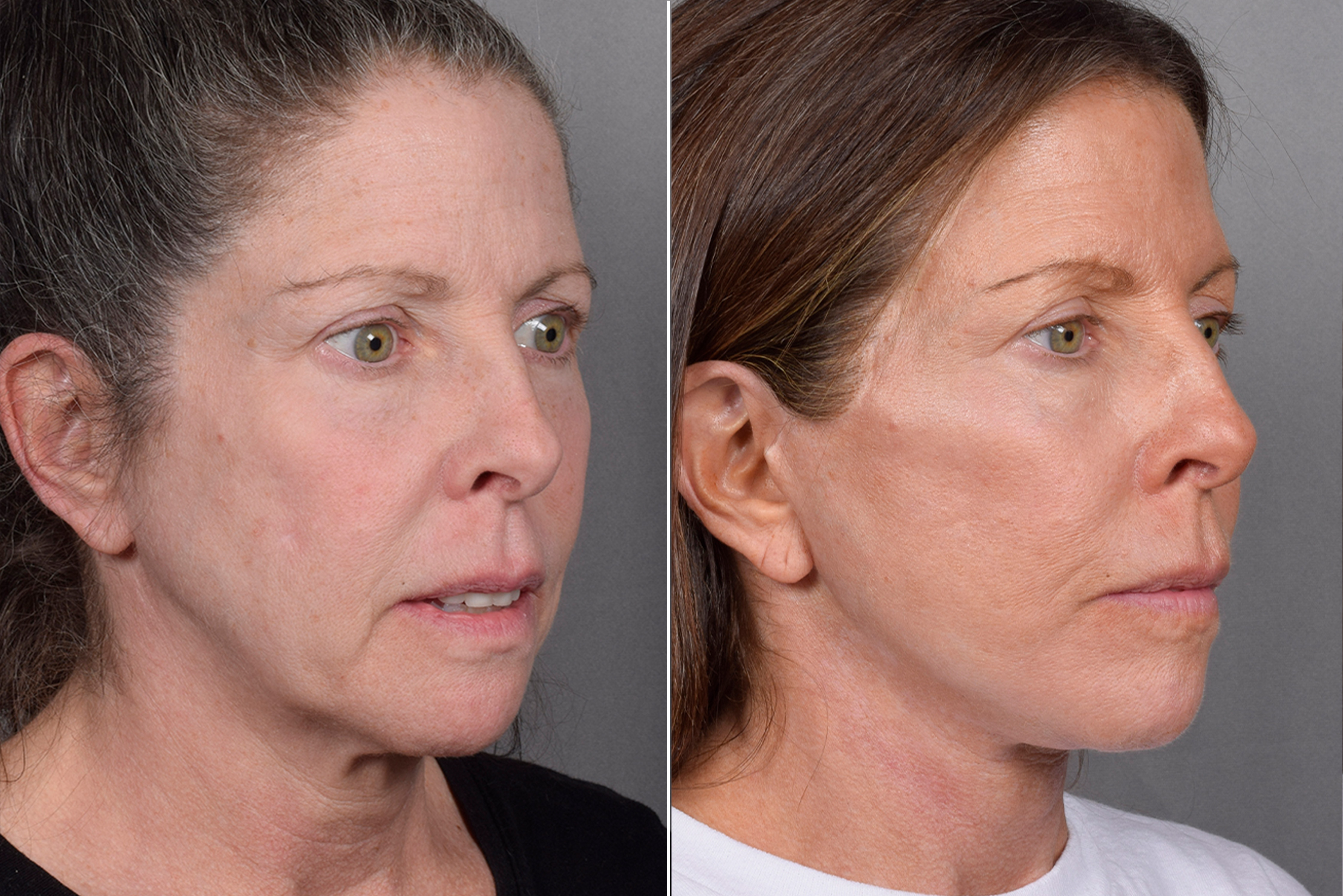 Neck Lift Before & After Gallery - Patient 607979 - Image 6