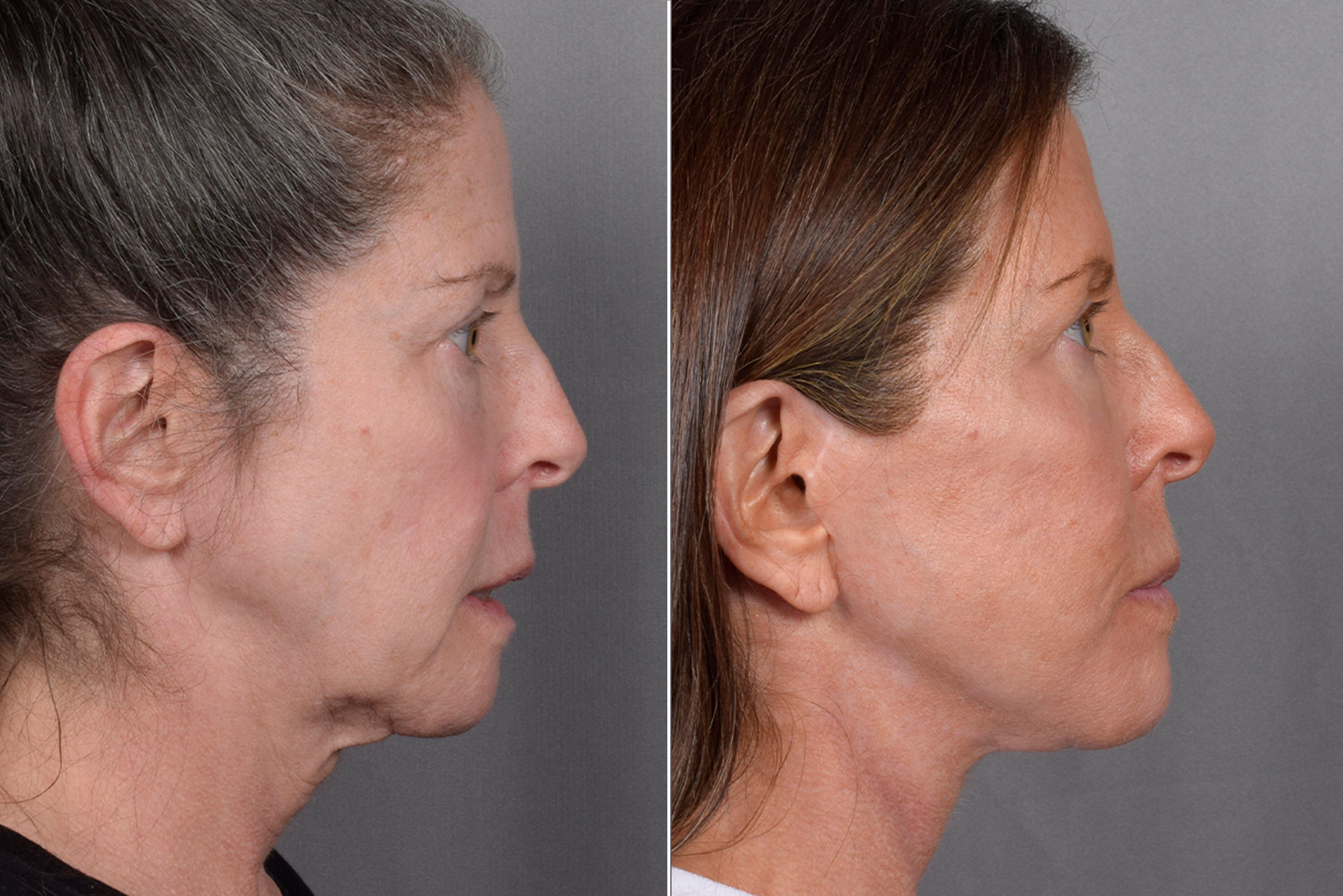Neck Lift Before & After Gallery - Patient 607979 - Image 7