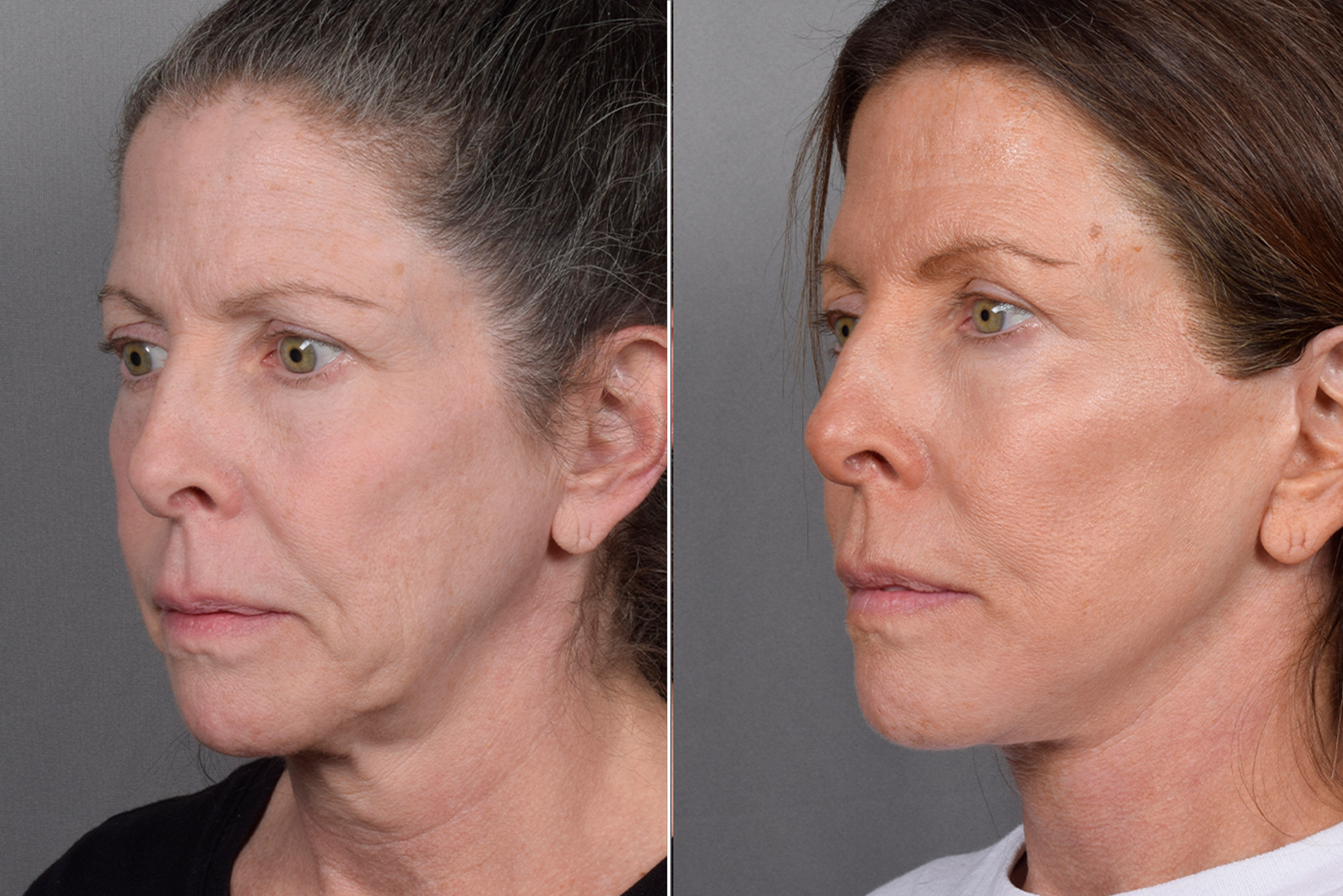 Neck Lift Before & After Gallery - Patient 607979 - Image 9