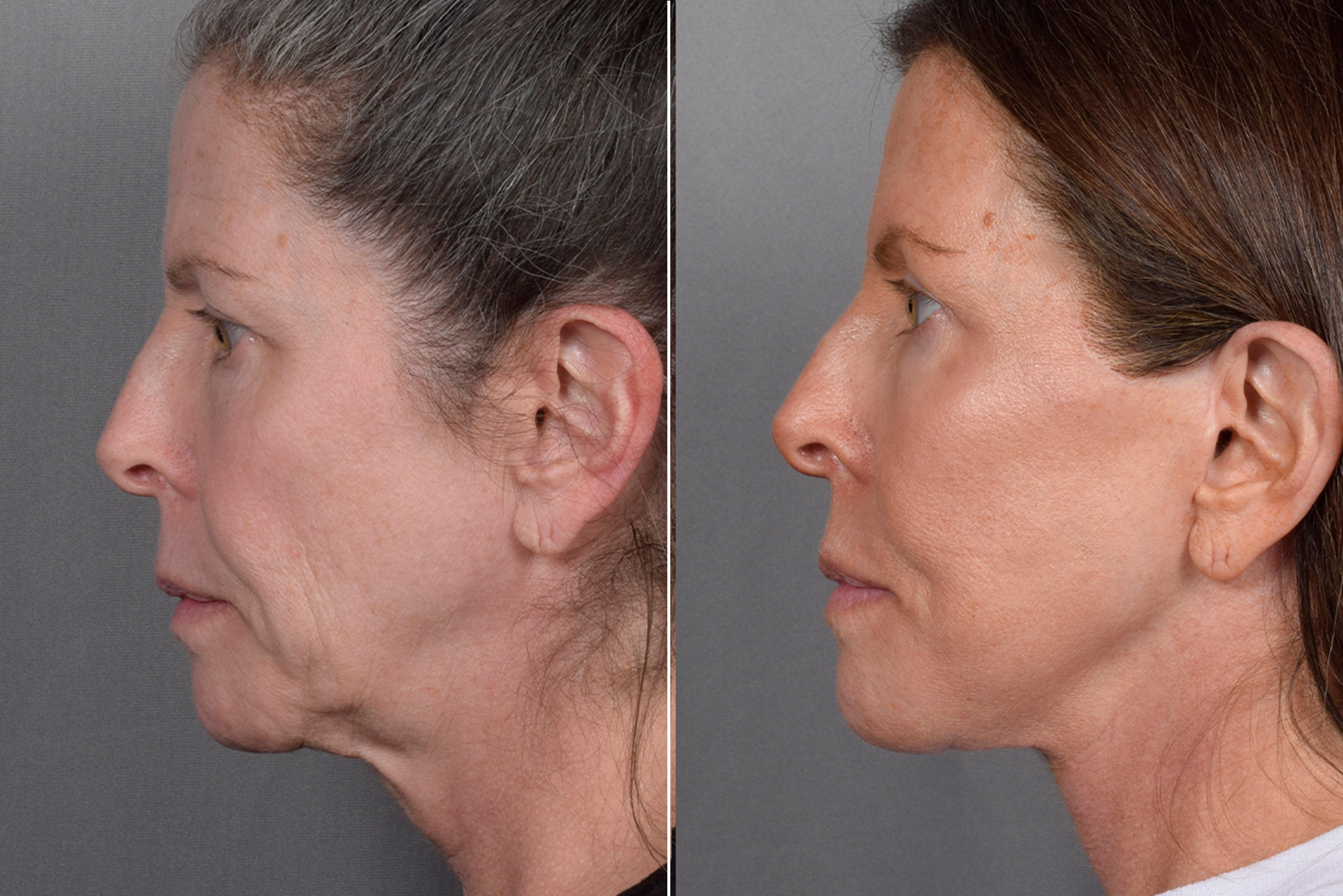 Neck Lift Before & After Gallery - Patient 607979 - Image 10