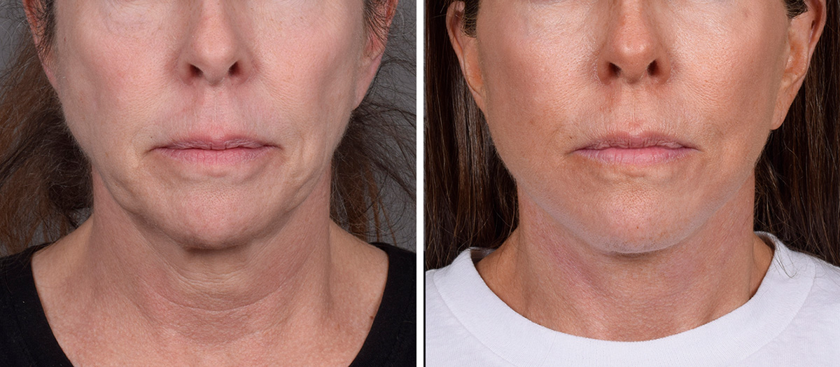 Neck Lift Before & After Gallery - Patient 607979 - Image 3