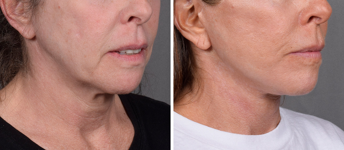 Neck Lift Before & After Gallery - Patient 607979 - Image 1