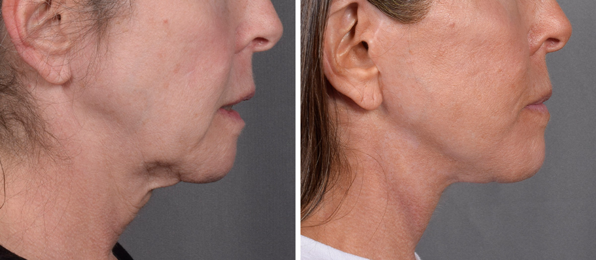 Neck Lift Before & After Gallery - Patient 607979 - Image 2