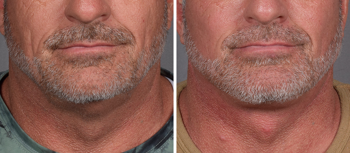 Neck Lift Before & After Gallery - Patient 384800 - Image 3