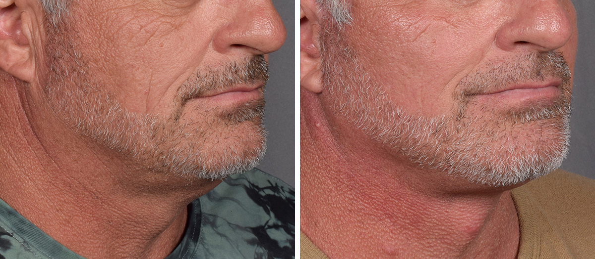 Neck Lift Before & After Gallery - Patient 384800 - Image 1