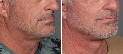 Neck Lift Before & After Gallery - Patient 384800 - Image 1