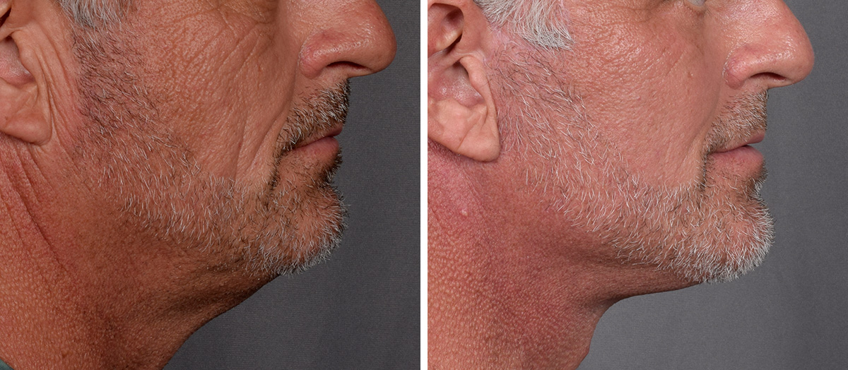 Neck Lift Before & After Gallery - Patient 384800 - Image 2
