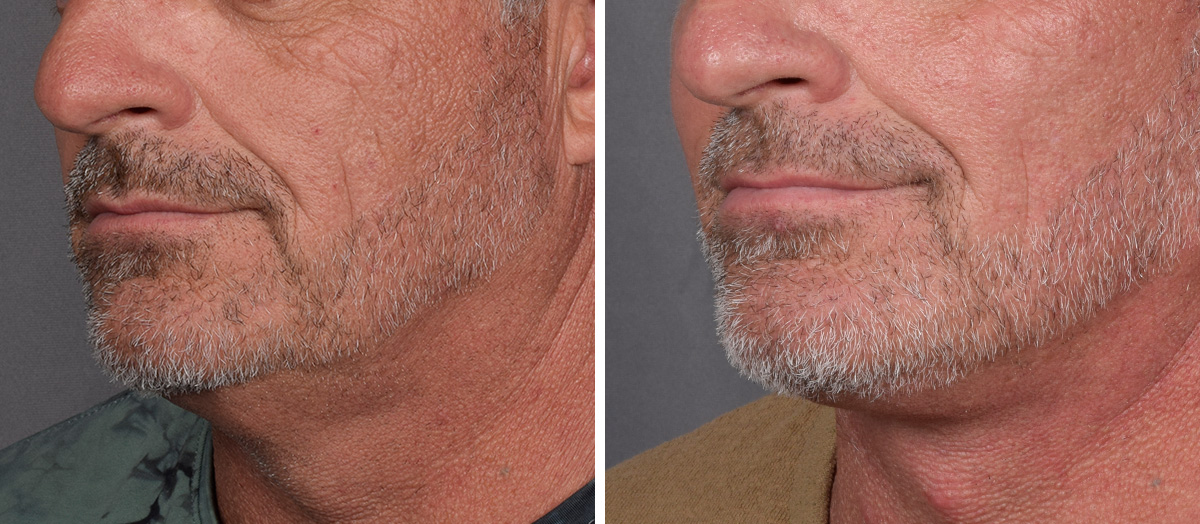 Neck Lift Before & After Gallery - Patient 384800 - Image 4