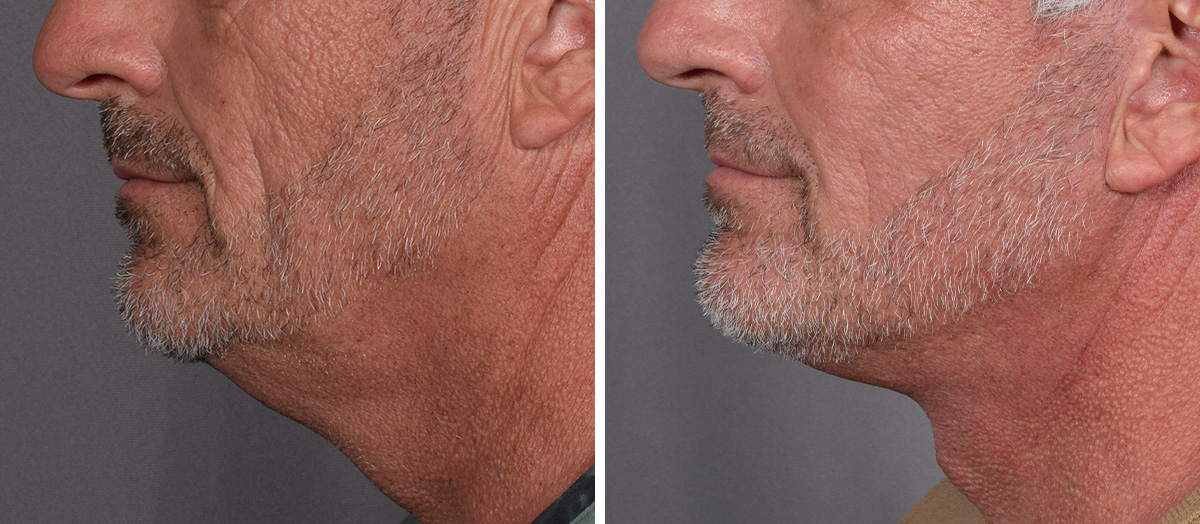 Neck Lift Before & After Gallery - Patient 384800 - Image 5