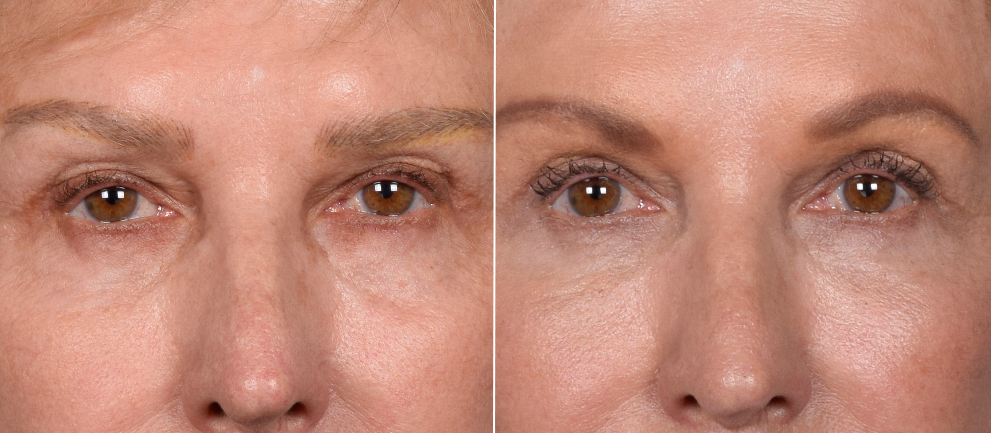 Lower Blepharoplasty Before & After Gallery - Patient 522575 - Image 1