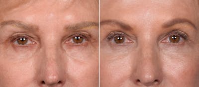 Lower Blepharoplasty Before & After Gallery - Patient 522575 - Image 1