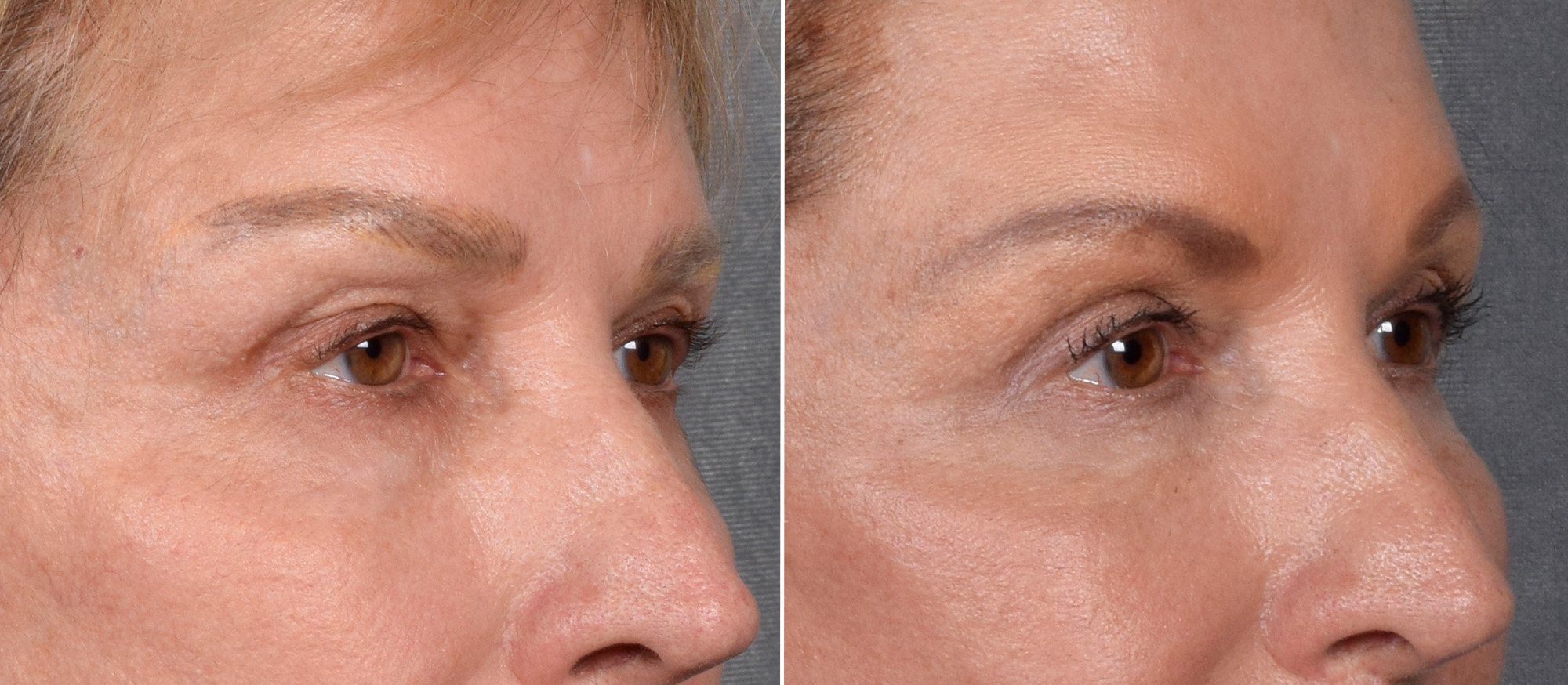 Lower Blepharoplasty Before & After Gallery - Patient 522575 - Image 2