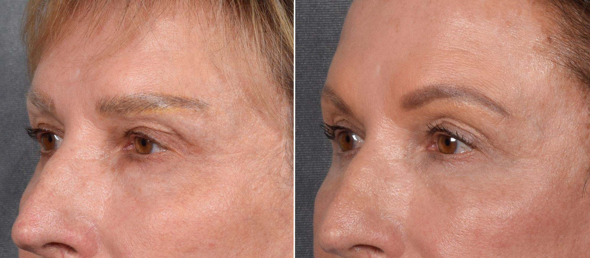 Lower Blepharoplasty Before & After Gallery - Patient 522575 - Image 4